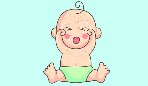 Síntomas de sarampión en bebés