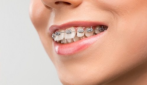 ¿A qué edad son recomendables los brackets?