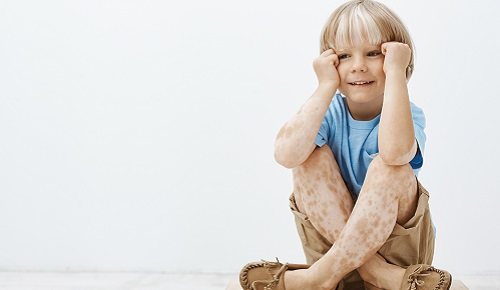 Manchas blancas en la piel de los niños en verano