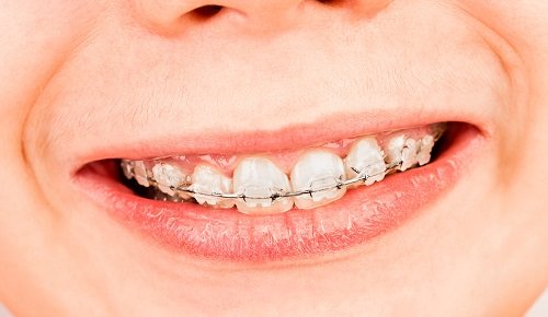 Maloclusiones dentales en niños