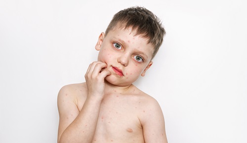 Síntomas y tratamiento de la escabiosis en niños