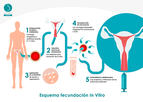 Reproducción asistida en parejas del mismo sexo: Método Ropa