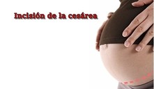 ¿cuántas cesáreas puede tener una mujer?