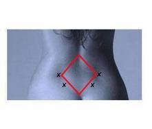 Inyecciones de agua estéril en el rombo de michaelis