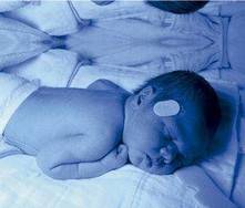 Anomalías vasculares en niños prematuros